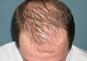 cause della caduta dei capelli