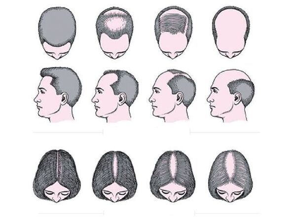 Alopecia androgenetica negli uomini e nelle donne