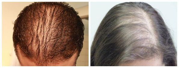 Alopecia diffusa