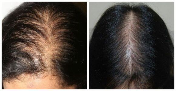 Perdita dei capelli nelle donne
