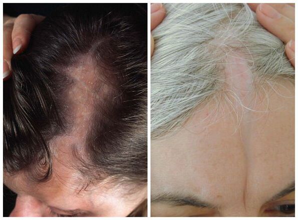 Sclerodermia del tipo “colpo di sciabola”.