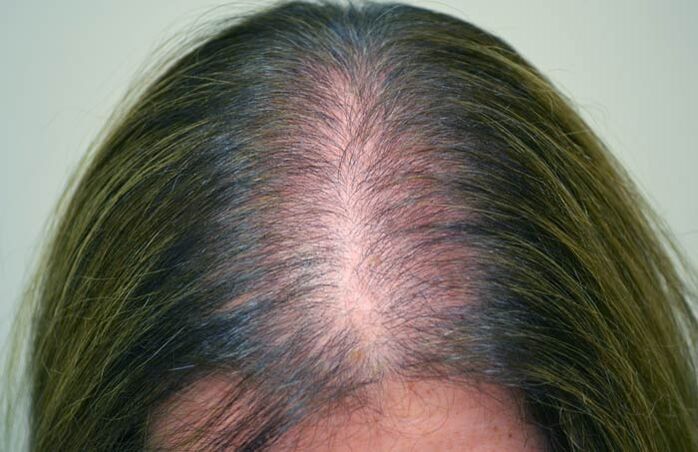 Alopecia (calvizie) nelle donne