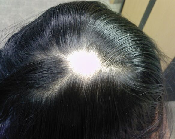 Alopecia areata o alopecia areata nelle donne