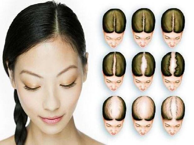 Fasi dell'alopecia nelle donne