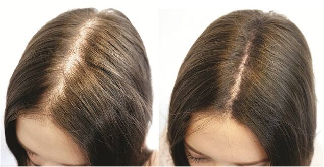 Il risultato del trattamento tempestivo dell’alopecia nelle donne