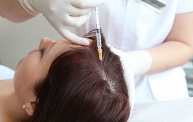 La mesoterapia nel trattamento dell'alopecia femminile