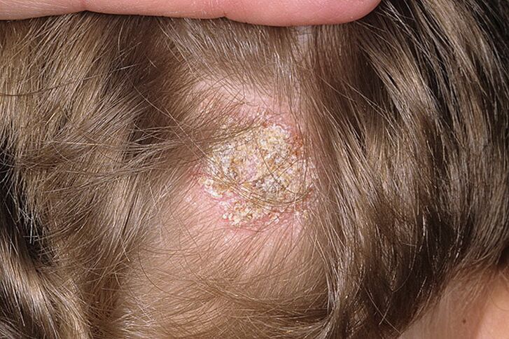 Tipo di alopecia seborroica nelle donne
