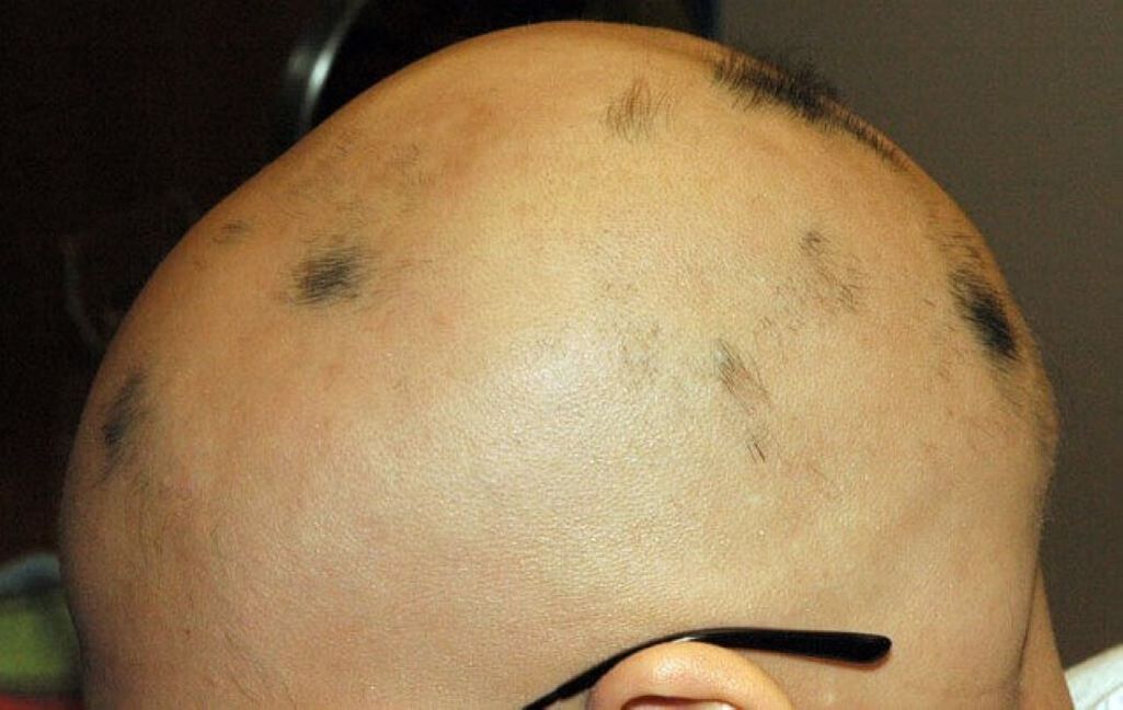 Alopecia totale del cuoio capelluto in un uomo