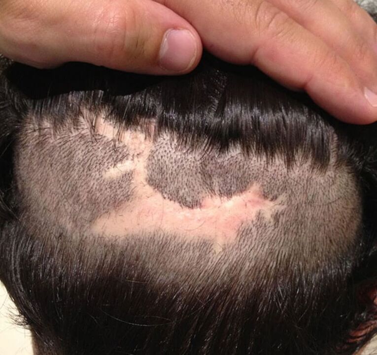alopecia cicatriziale del cuoio capelluto