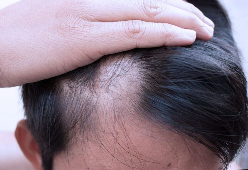alopecia diffusa della testa