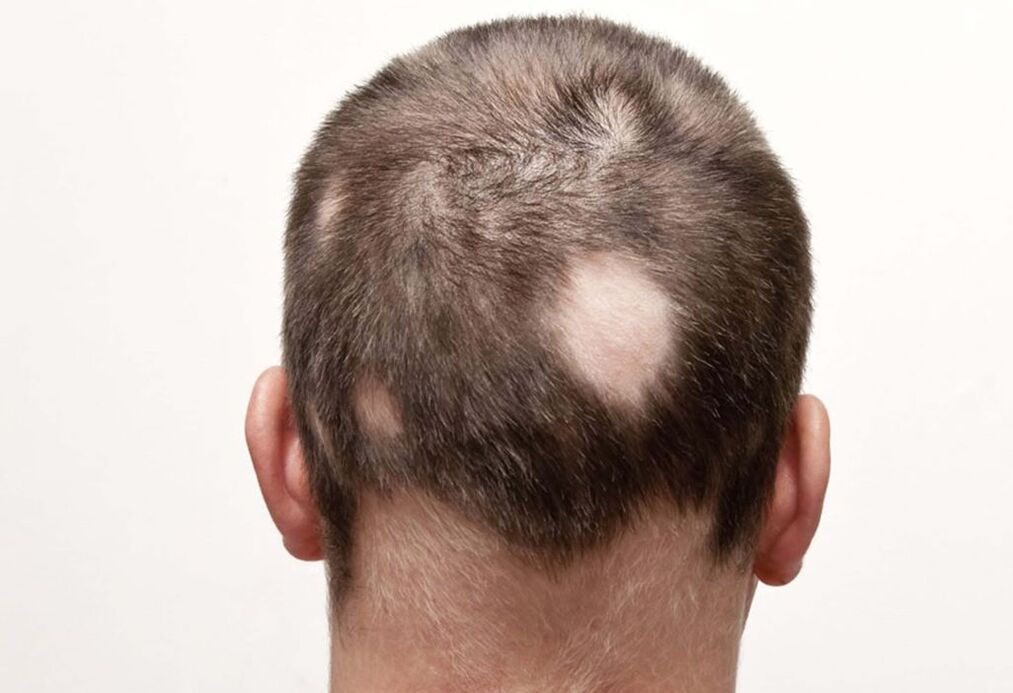 alopecia nidificante (focale) della testa