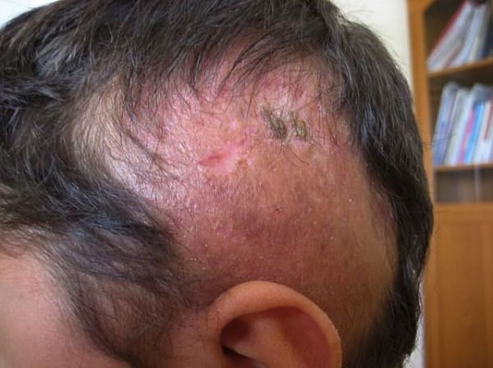 area della lesione del cuoio capelluto in un uomo