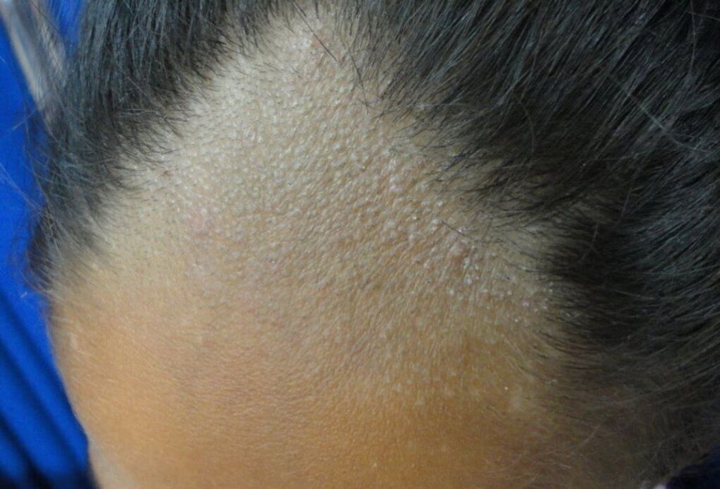 infezione del cuoio capelluto in un uomo