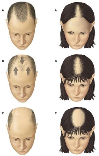 Alopecia androgenetica negli uomini e nelle donne