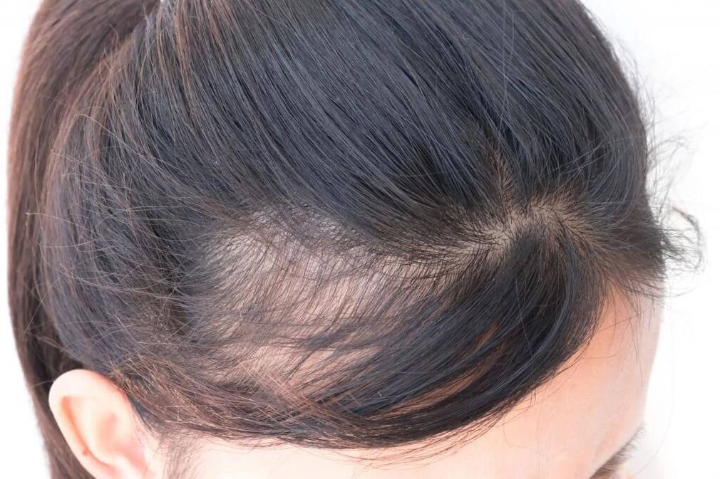 Alopecia androgenetica nelle donne