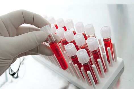 Esame del sangue per prescrivere un trattamento individuale per l'alopecia