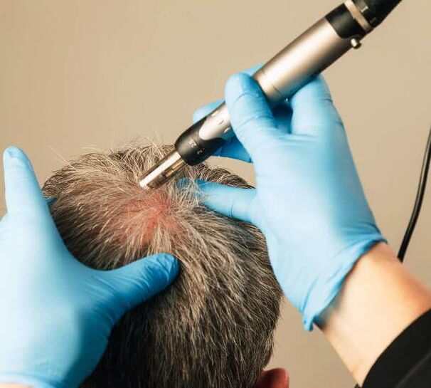 Fisioterapia per il trattamento dell'alopecia androgenetica