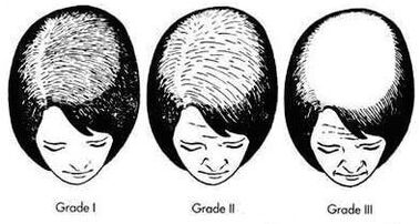 Gradi di calvizie androgenica femminile
