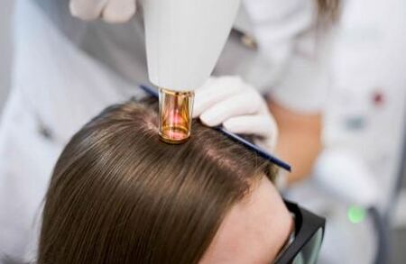 Laserterapia per l’alopecia androgenetica