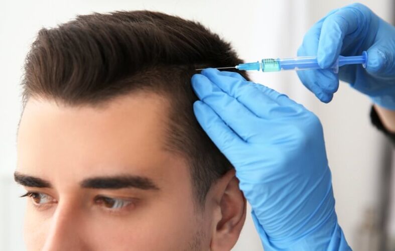 Mesoterapia per stimolare la crescita dei capelli nell'alopecia androgenetica